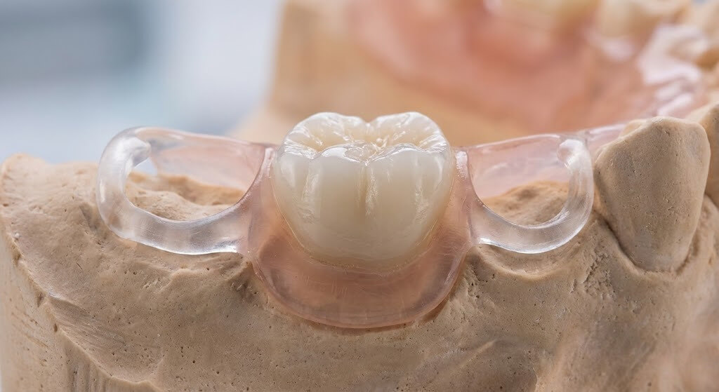 Протезирование одного зуба протезом-абочкой