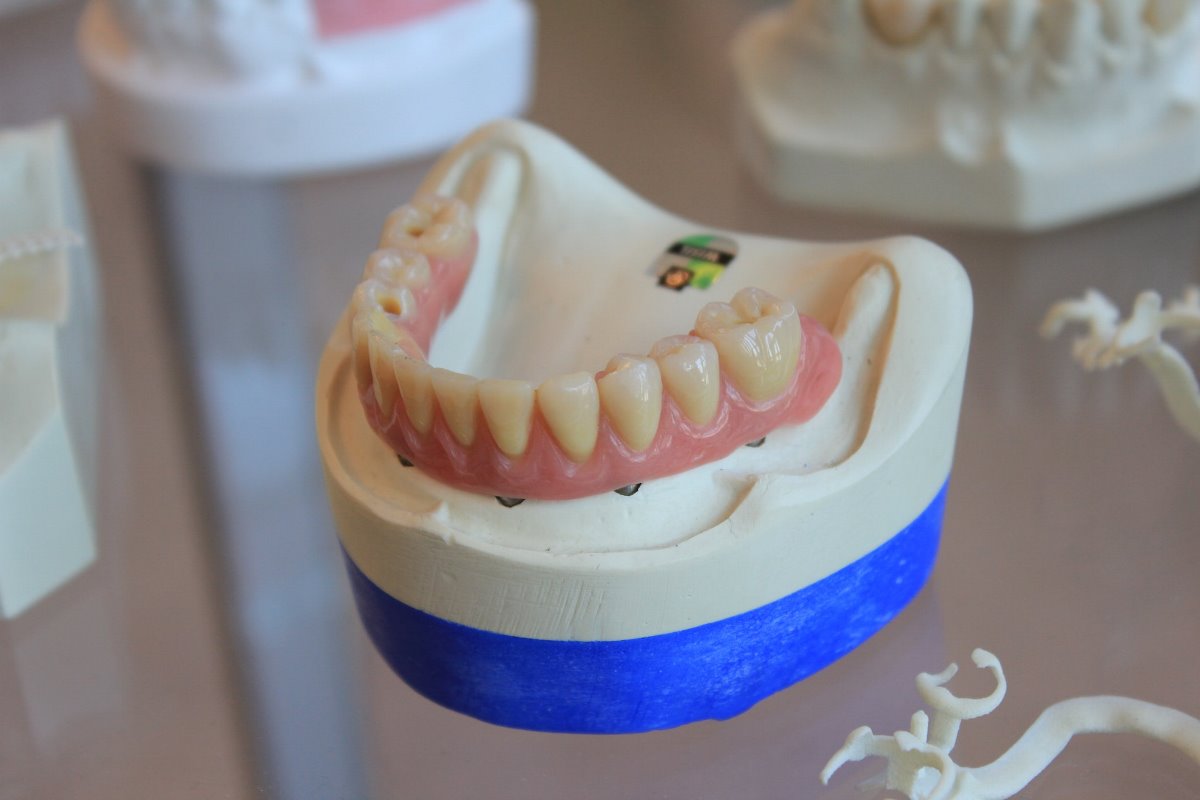 Типы зубных имплантов