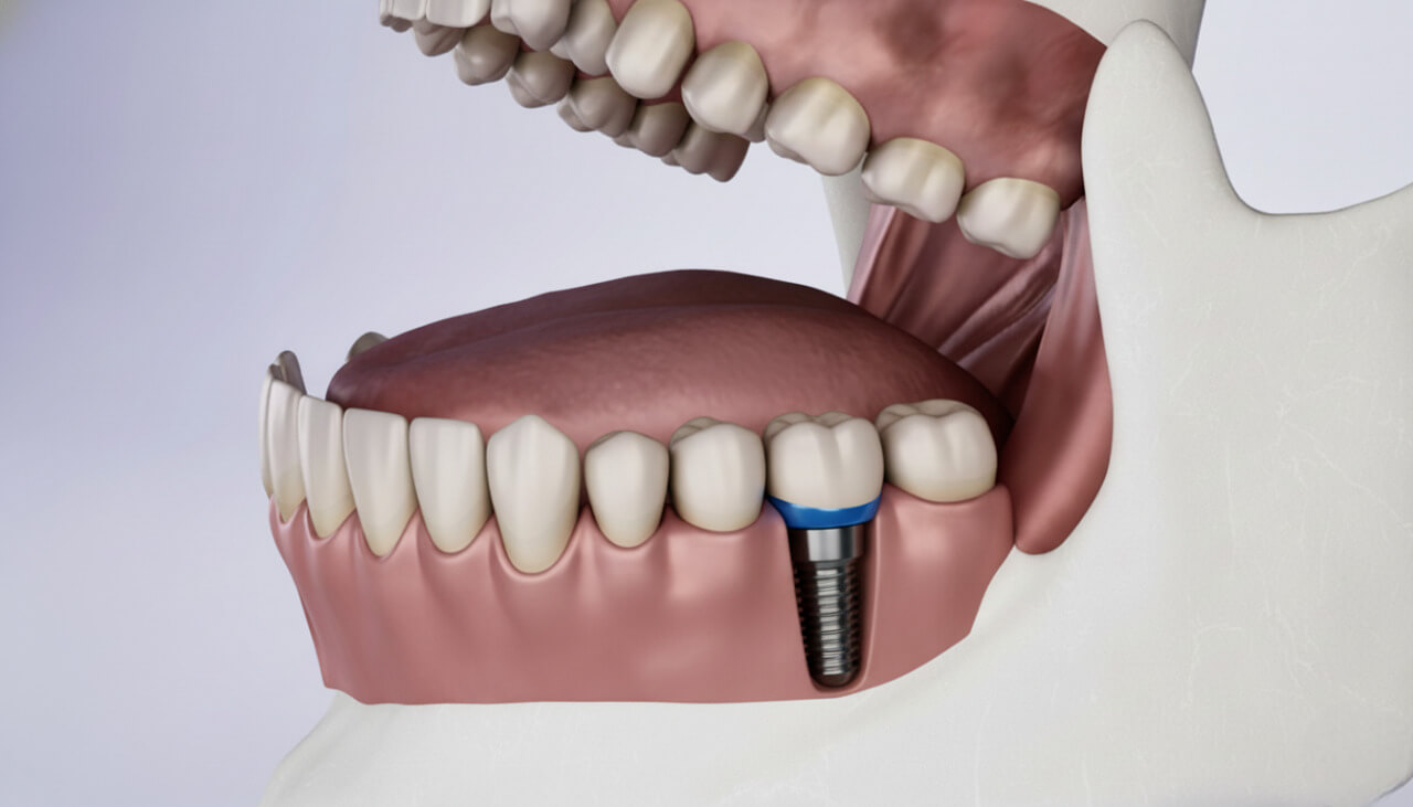 Зуб на импланте в члеюсти
